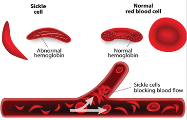 Sickle Cell Disease in India